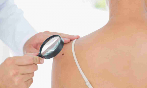 Cancro della pelle, oltre ai nei sospetti fai attenzione a questo sintomo: è spesso sottovalutato